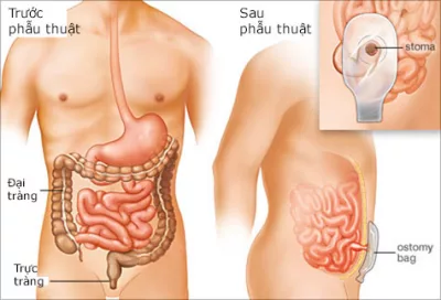 Colon resection