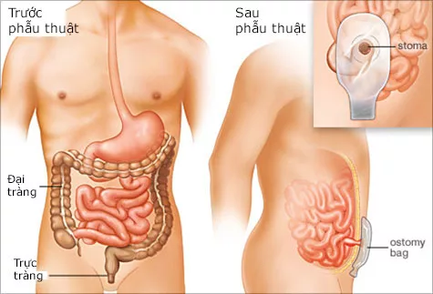 Colon resection