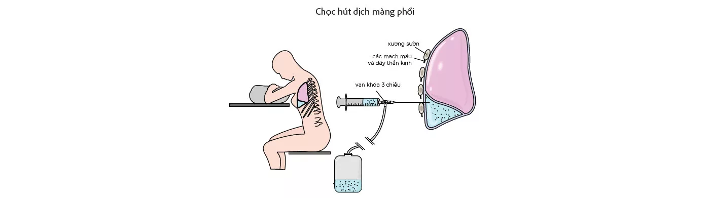 chọc hút dịch màng phổi