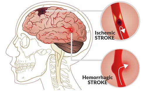 Tai biến mạch máu não: Những điều cần chú ý