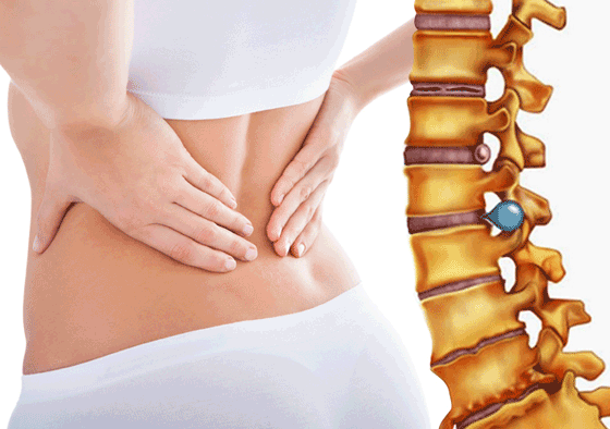 Herniated disc