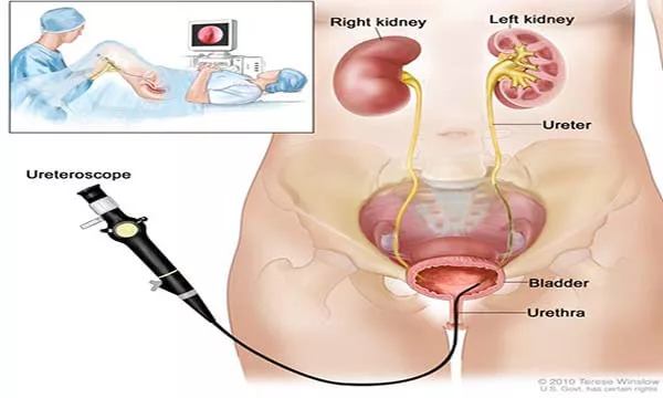 Ureteroscopy in diagnosis &amp; treatment of ureteral pathology