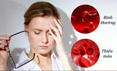 Iron-deficiency anemia