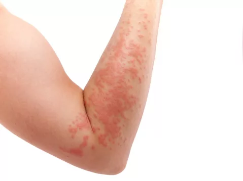 Does your child have itchy, red skin? It may be Atopic Dermatitis
