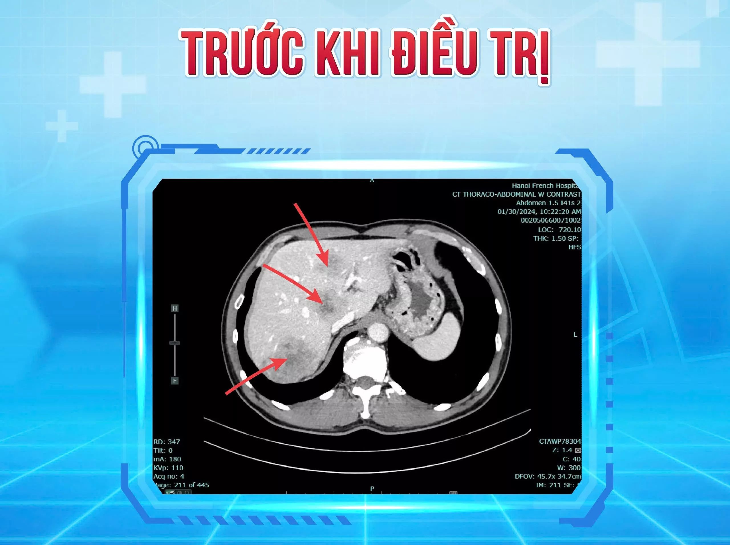 truoc dieu tri
