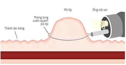 Pô-lyp đại tràng
