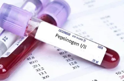 Pepsinogen - Giải pháp sàng lọc sớm ung thư dạ dày