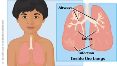Viêm phổi ở trẻ em