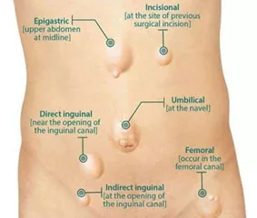 Thoát vị bẹn và điều trị