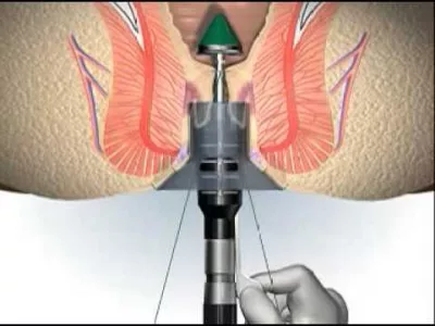 Longo – phương pháp mổ trĩ không đau