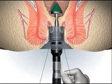 Longo – phương pháp mổ trĩ không đau