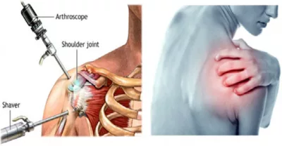 Nội soi khớp vai - Kỹ thuật ít xâm lấn điều trị bệnh lý khớp vai