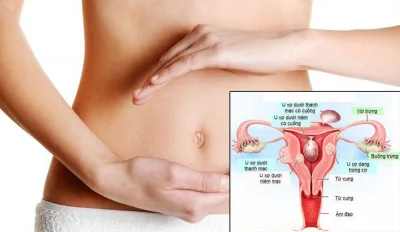 Điều trị u xơ tử cung bằng phương pháp can thiệp bảo tồn, ít xâm lấn
