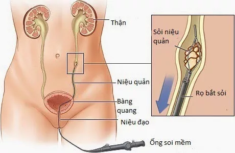 Nội soi niệu quản điều trị hẹp niệu quản