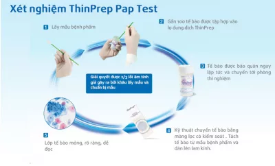 ThinPrep Test - Tiến bộ mới trong phát hiện sớm ung thư cổ tử cung